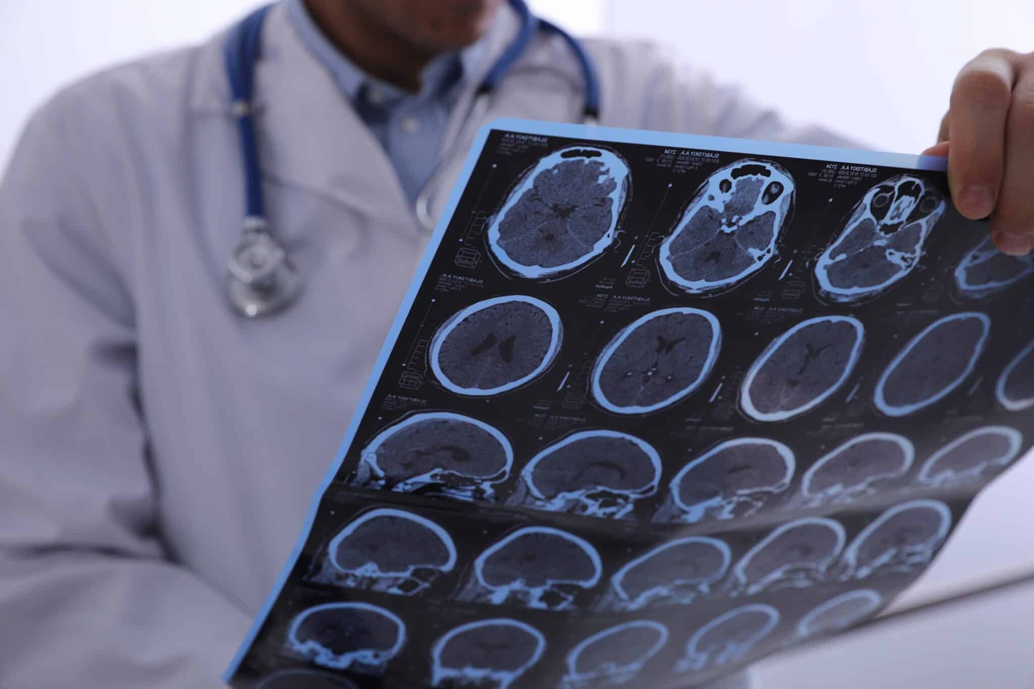 Concussion Symptoms After a Car Accident